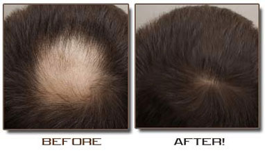 Baldness on Revolutionary Baldness Cure    Ask Tony C     Information Specialist
